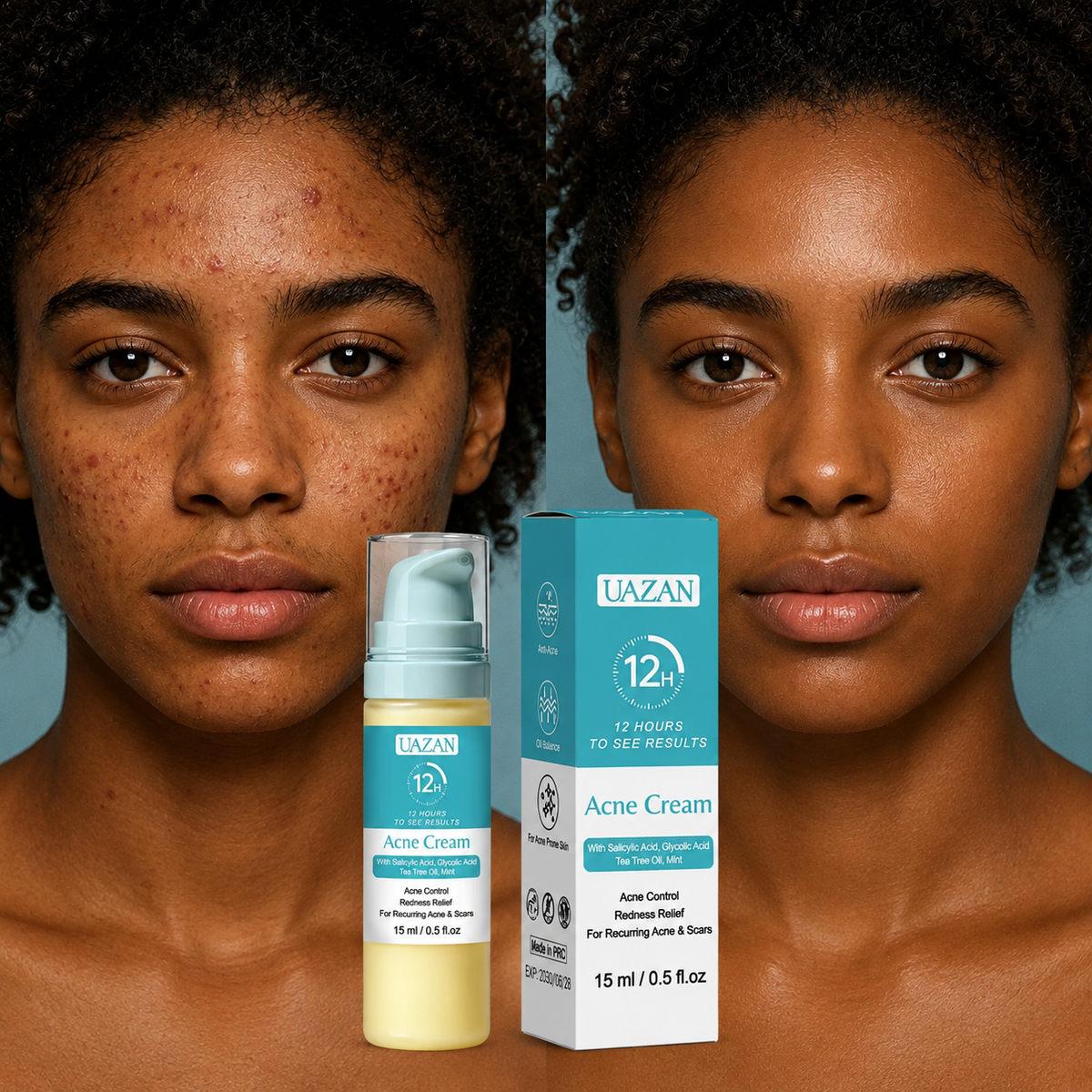 Crème anti-acné