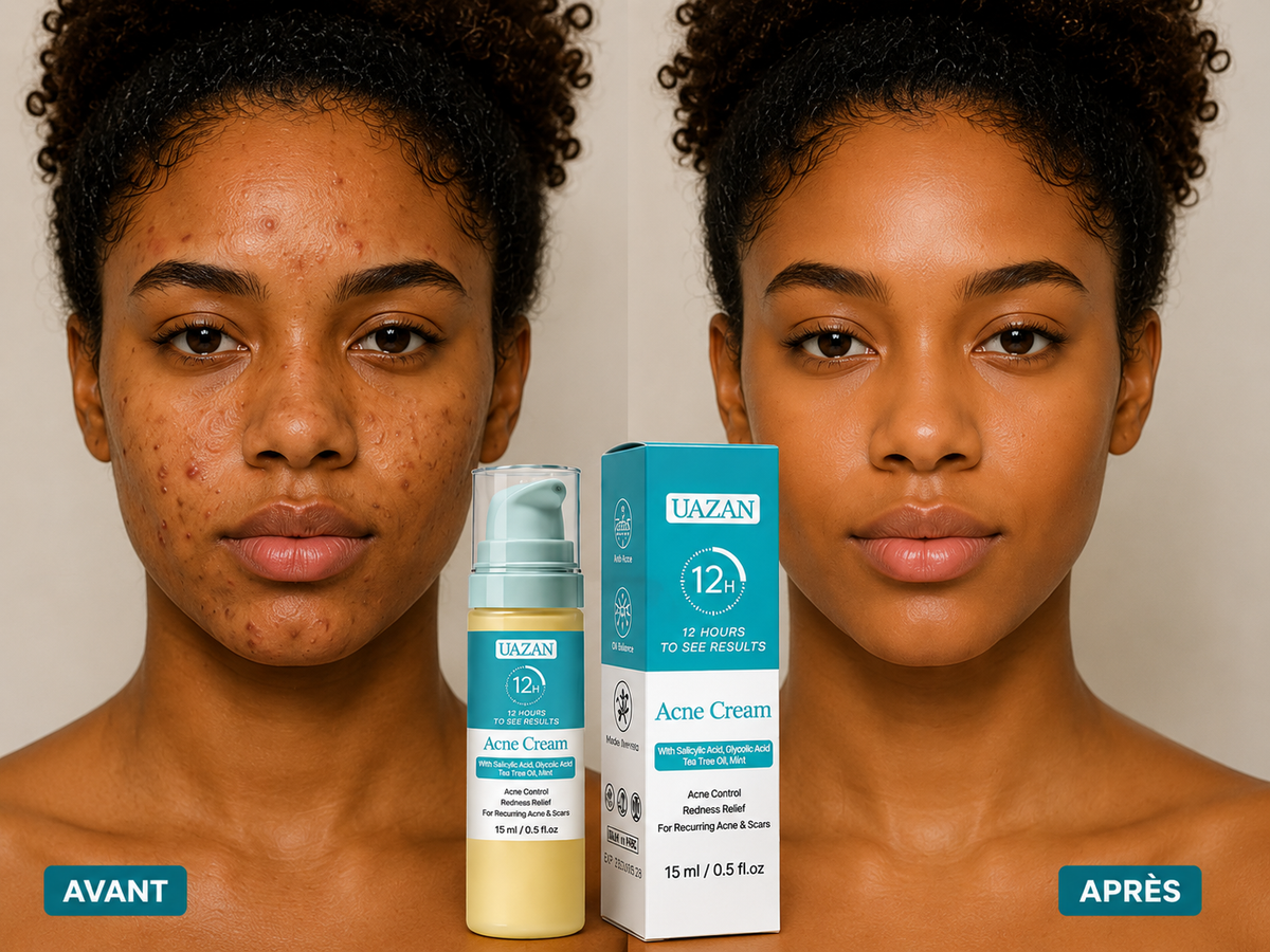 Crème anti-acné